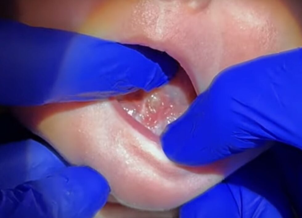 Wound Care and Stretching After TongueTie Release
