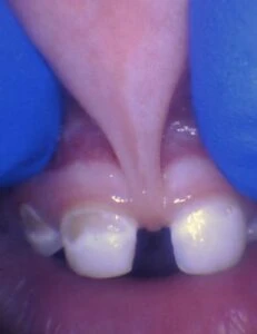 Image of lip tie in toddler