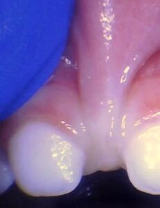 Image of lip tie in toddler