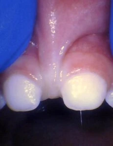 Image of lip tie in toddler