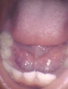 Image of tongue tie in toddler