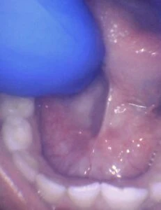 Image of tongue tie in toddler