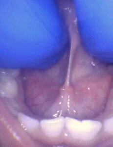 Image of tongue tie in toddler