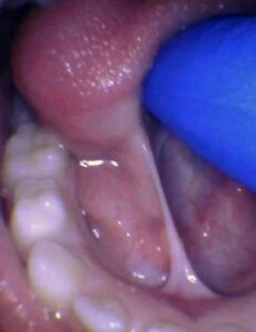 Image of tongue tie in toddler