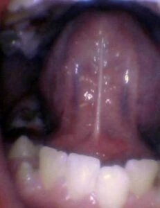 Image of tongue tie in toddler
