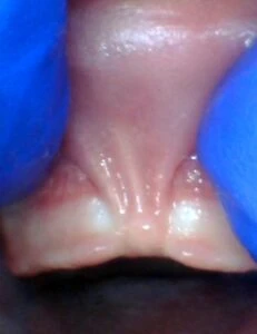 Image of lip tie in infant