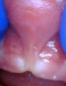 Image of lip tie in infant