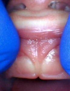Image of lip tie in infant