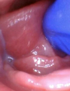 Image of tongue tie in infant