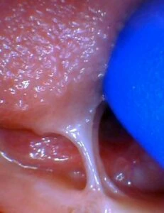 Image of tongue tie in infant