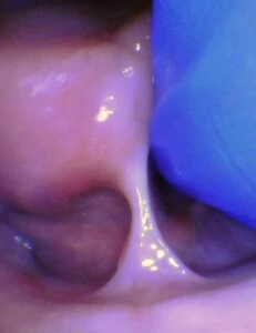 Image of tongue tie in infant