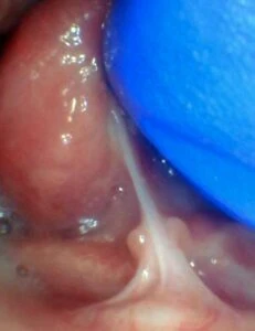 Image of tongue tie in infant