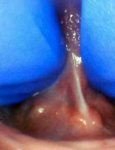 Image of tongue tie in infant