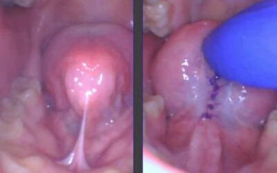 Can Adults Have a Tongue-Tie? Find Out The Facts.