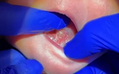 Wound Care and Stretching After Tongue-Tie Release