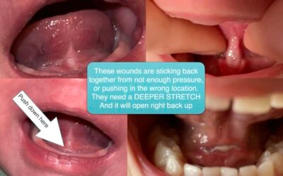 Preventing Reattachment After a Tongue-Tie Release: What Parents Need to Know About Stretches