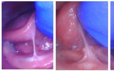Respectfully, Your Scale Needs Calibrating: Why a To-The-Tip Tongue-Tie is NOT Mild
