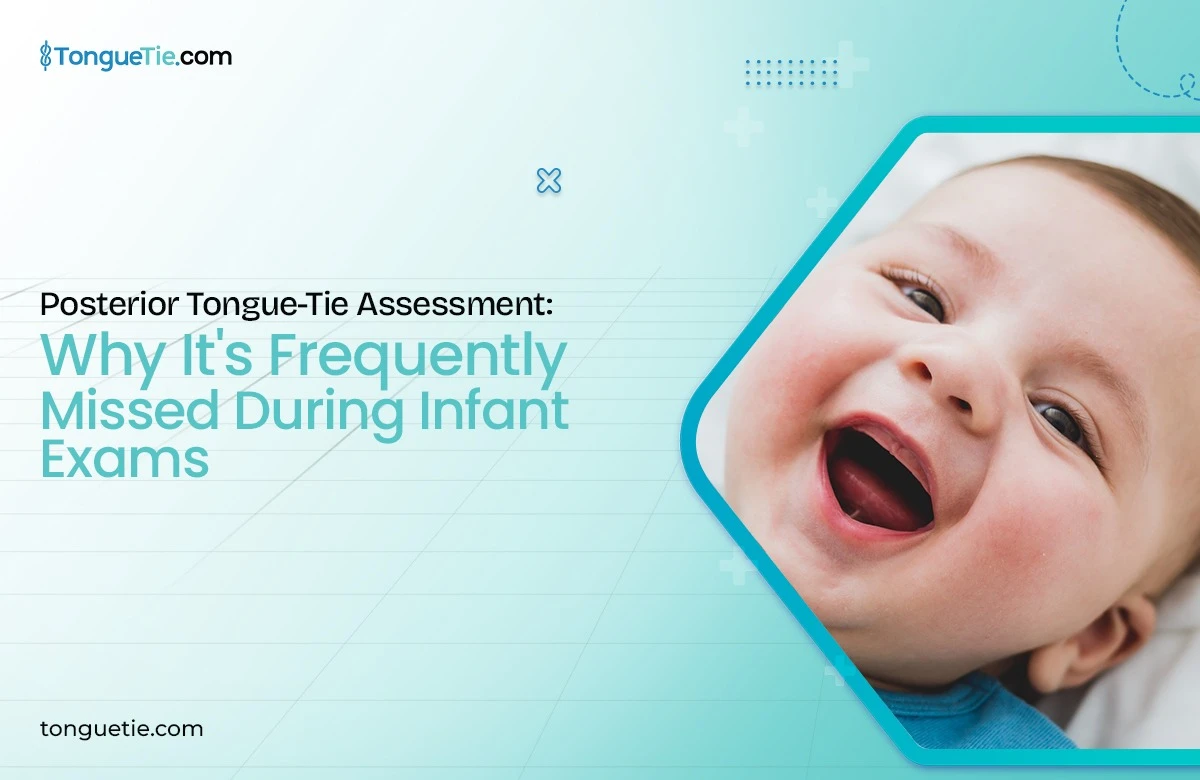Posterior Tongue-Tie Assessment Posterior Tongue-Tie Assessment: Why Function Matters